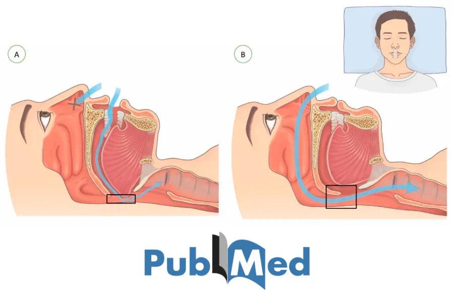 El impacto de la cinta bucal en respiradores bucales con apnea obstructiva del sueño leve: Un estudio de PubMed